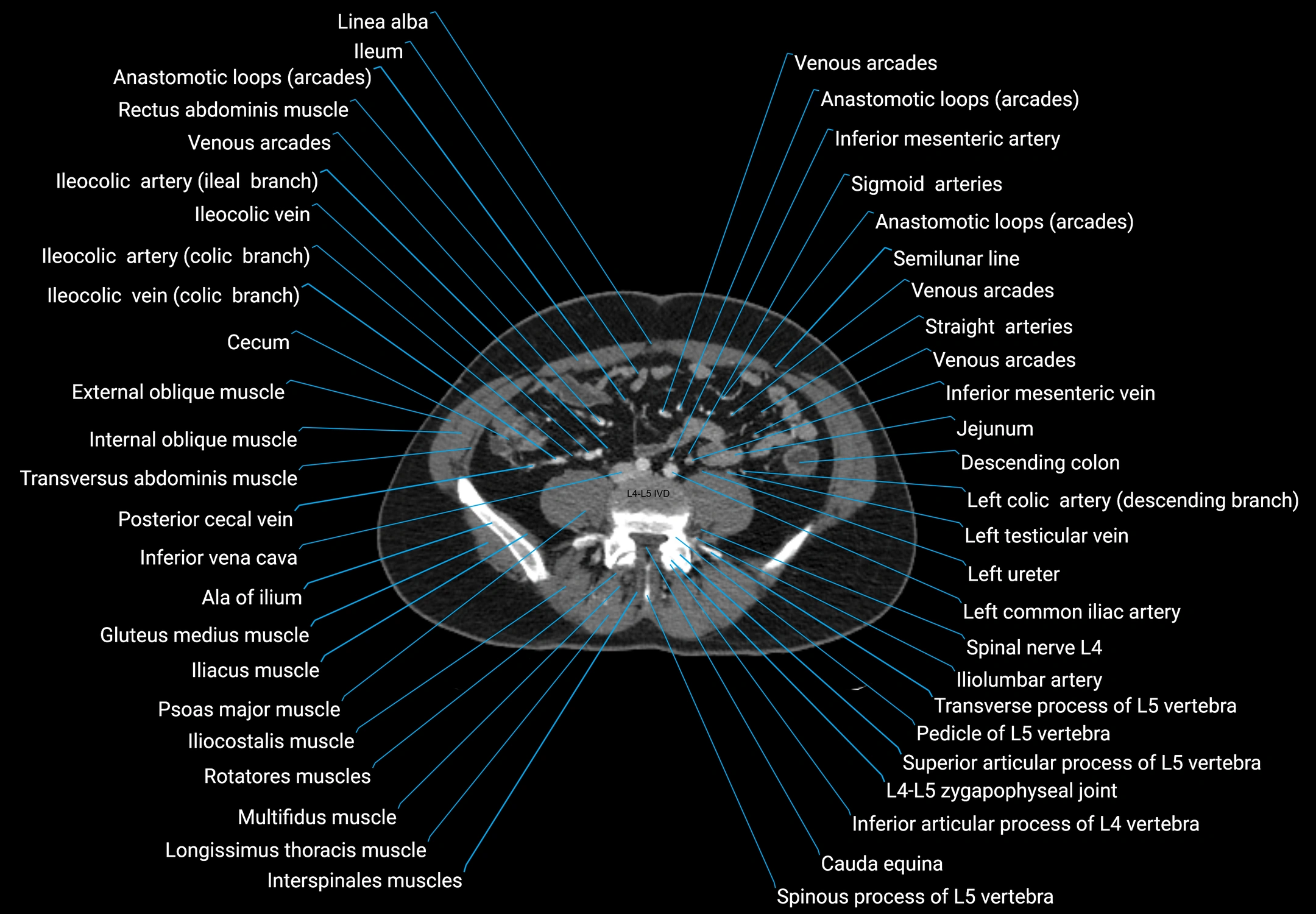 CT male pelvis axial cross sectional anatomy labelled radiology image -00120.webp